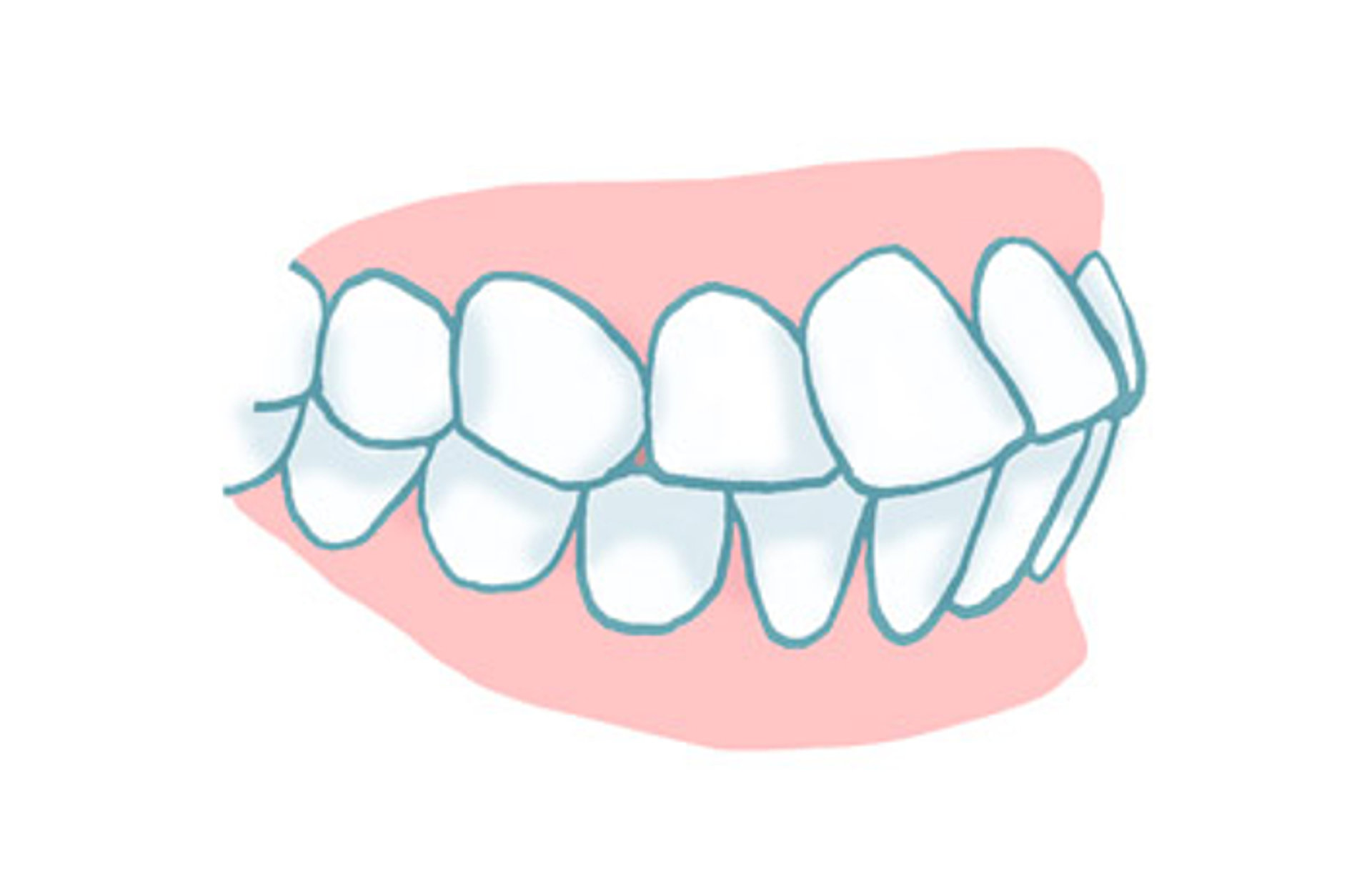 Protrusion