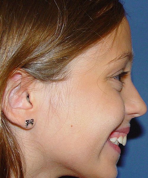 Iris vorher