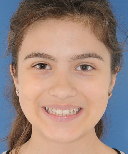 Jaqueline vorher