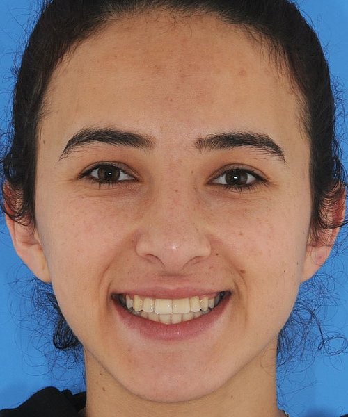 Nesrin nachher