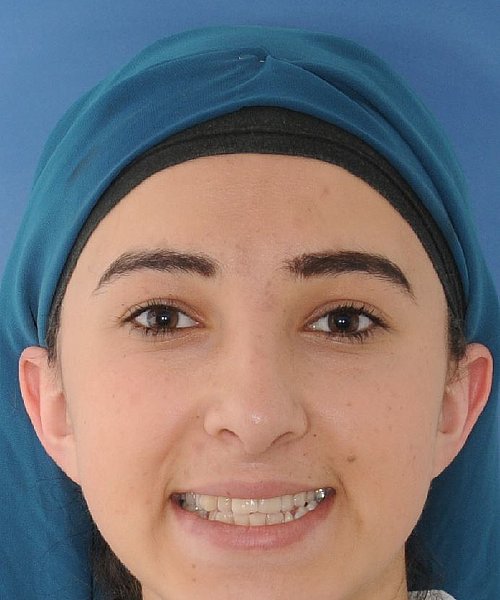 Nesrin vorher