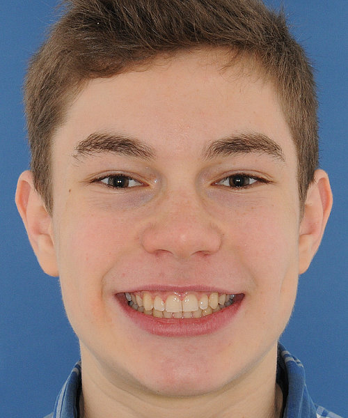 Philipp nachher