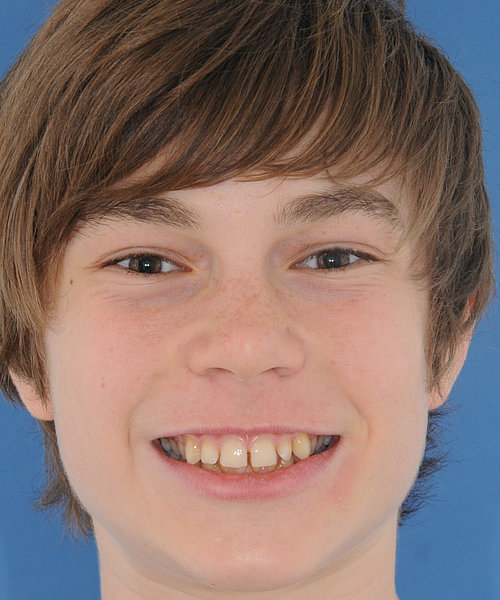 Philipp vorher